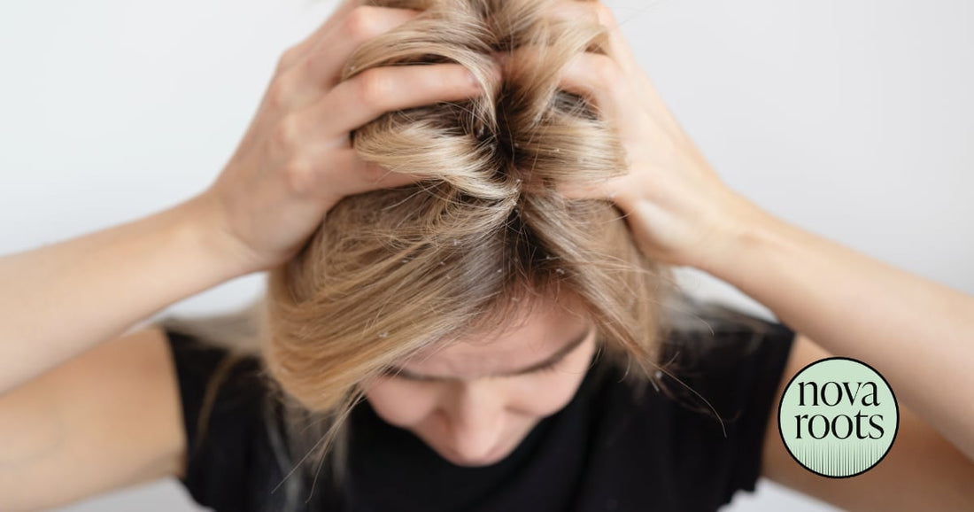 Ako alergie ovplyvňujú vlasy a pokožku hlavy?